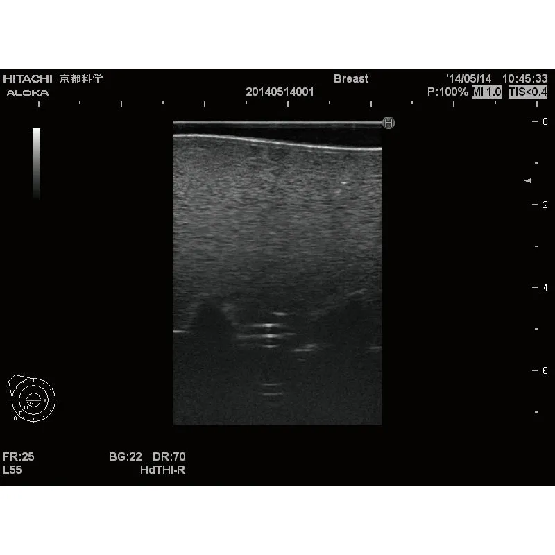 Ultrasound Lumbar Puncture Simulator