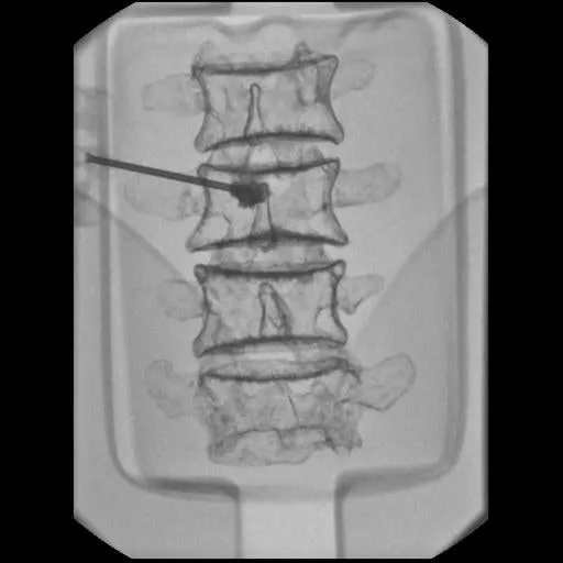 Ultrasound Lumbar Puncture Simulator