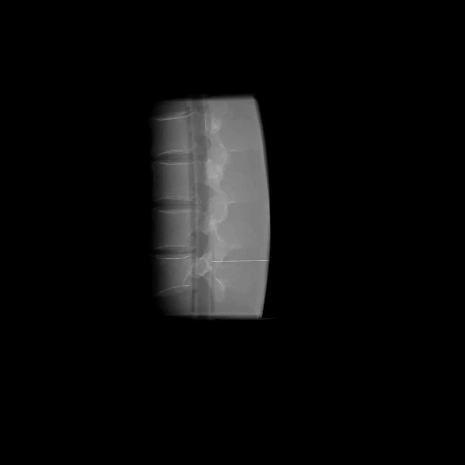 Ultrasound Lumbar Puncture Simulator