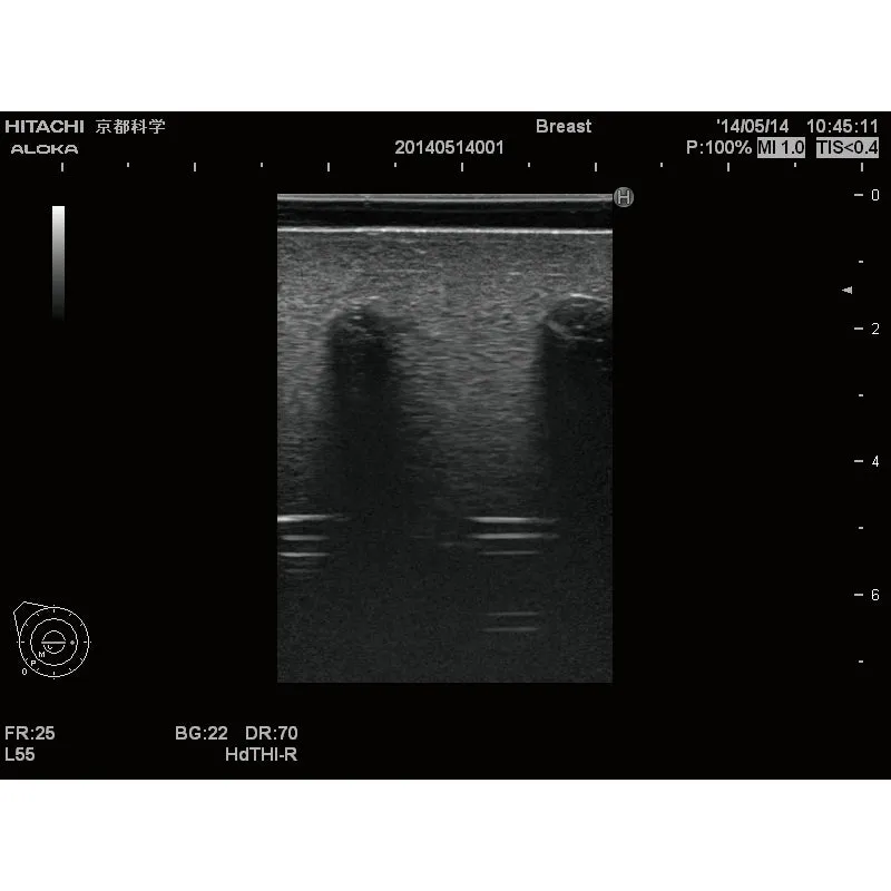 Ultrasound Lumbar Puncture Simulator